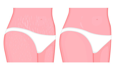 Vector illustration of human body problem. Healing of stretch marks on European, Asian women belly and legs. For advertising, medical publications, use on package of medicinal products, creams