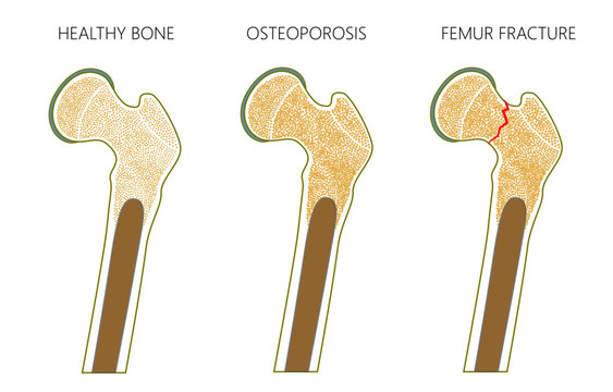 Vector illustration of a healthy human thigh bone,  osteoporosis of femur and femoral neck fracture without dislocation isolated on white background. For advertising and medical publications