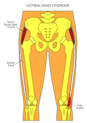 Vector illustration of a human pelvis, hip and a knee joint with iliotibial band (tract) syndrome. Front view. For advertising and medical publications