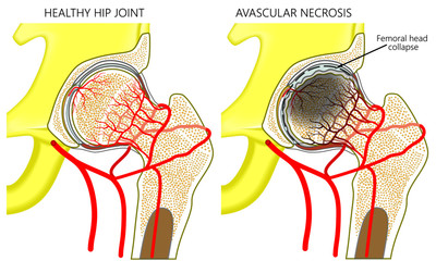 Vector illustration anatomy of a healthy human hip joint and a hip with avascular necrosis of the femoral head. Front view. For advertising and medical publications