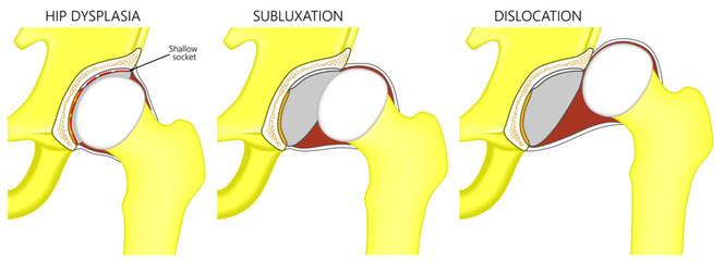Vector illustration anatomy of a hip joint with dysplasia, subluxation and dislocation of the femoral head in the joint . Front view. For advertising and medical publications.