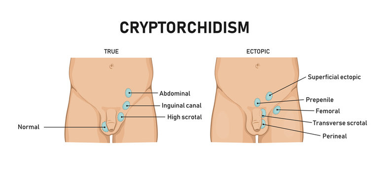 Cryptorchidism - absence of one or both testes from the scrotum