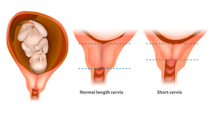 Normal length cervix and short cervix in Pregnancy. The cervix or cervix uteri - obrazy, fototapety, plakaty