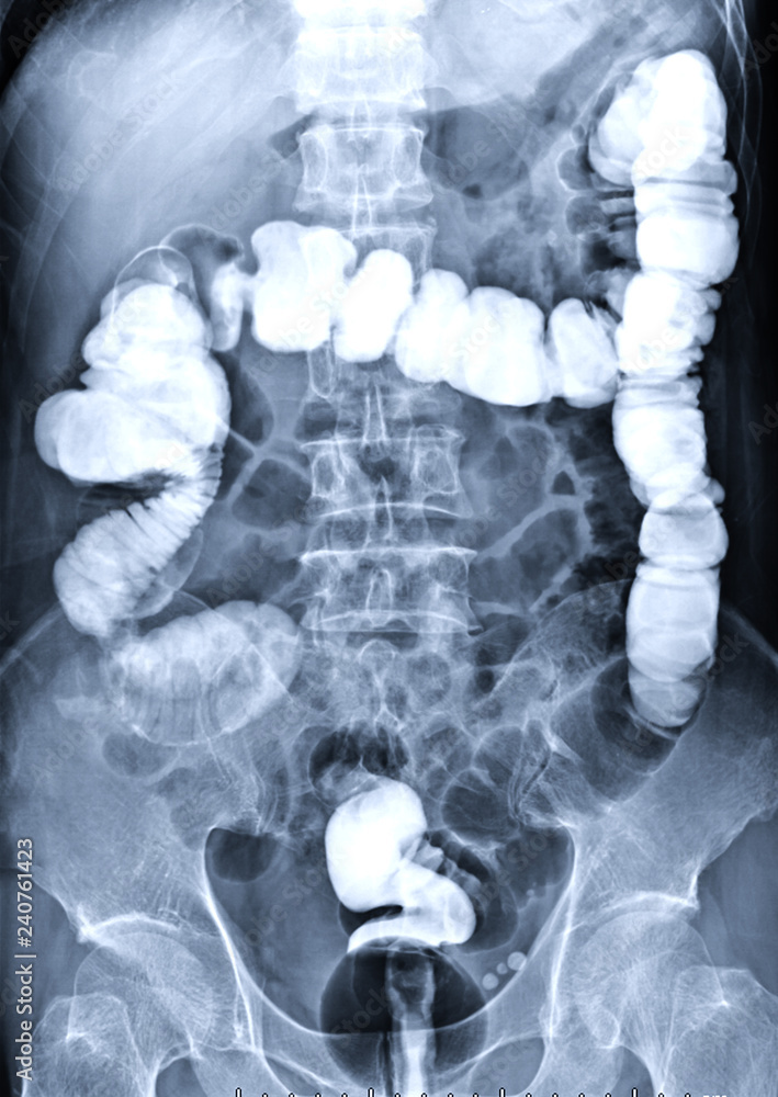 Poster barium enema image front view is a rectal injection of barium contrast. this coats the lining of the