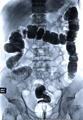  barium enema image front view is a rectal injection of barium contrast. This coats the lining of...