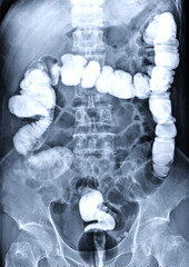  barium enema image front view is a rectal injection of barium contrast. This coats the lining of the colon and rectum and X-ray films are obtained under fluoroscopic control.