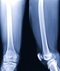 Radiographic image or x-ray image of Right femur bone.