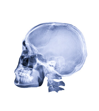  x-ray image of Human skull  Lateral view or side view isolated on white Background. Clipping path.