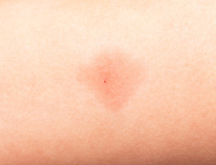 redness on the skin from vaccinations in a child