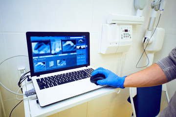 doctor's hand in blue gloves holds a mouse on a laptop
