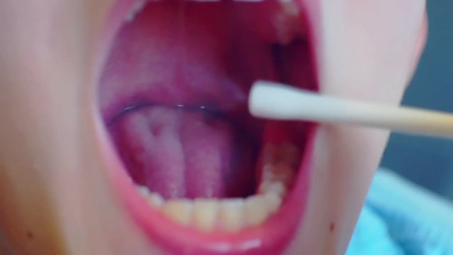 sore mouth and throat are treated with medication as a spray.close-up