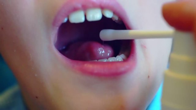 sore mouth and throat are treated with medication as a spray.close-up