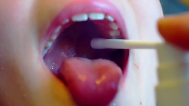 sore mouth and throat are treated with medication as a spray.close-up