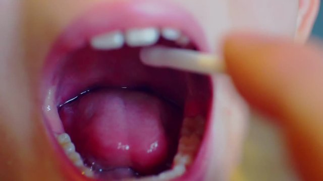 sore mouth and throat are treated with medication as a spray.close-up
