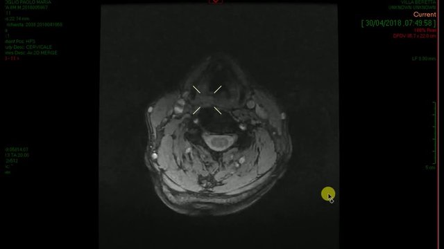 TAC colonna cervicale