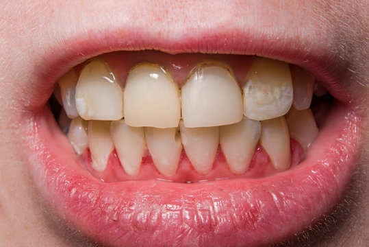 Yellow uneven broken teeth