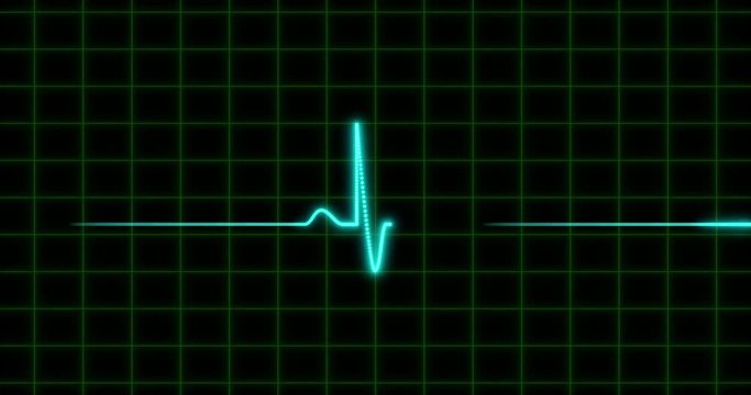 EKG Normal Heart Attack Congestive Heart Failure cardiovascular disease concept 