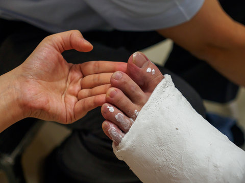 Closeup detail of a  nurse supporting a patient's foot while their orthopedic foot cast for a tibial bone fracture cures and hardens. Healthcare and trauma medicine.
