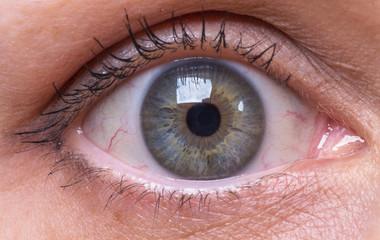 Red eye of a woman