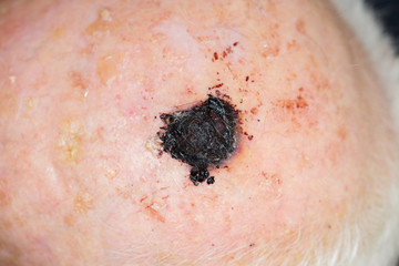 Malignant melanoma on the head of an old caucasian man - obrazy, fototapety, plakaty