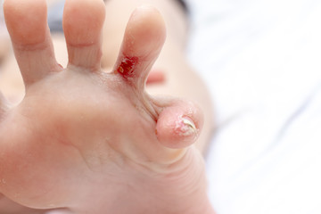 Naklejka premium Dyshydrotic eczema, atopic dermatitis injury, damage on foot and toes of a child. Dermatology and pediatrics concept. Fungal infection treatment