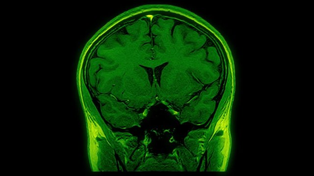 Computed medical tomography MRI upscaled scan of healthy young female brain. Front/rear view. Optically retimed for smooth motion. Green on black background.