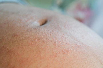 an irritated skin during pregnancy