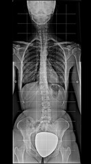 X-ray of human body, from chest to pelvis, complete spinal, scoliosis, front view