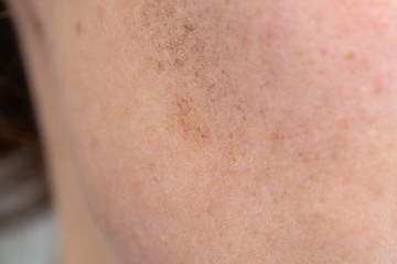 Closeup shot of skin blemishes