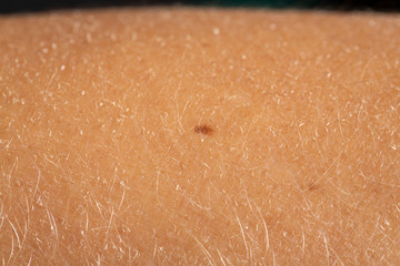 Closeup shot of skin blemishes