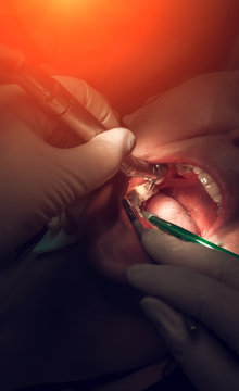 treatment of tooth caries at sunset, dental  close-up.