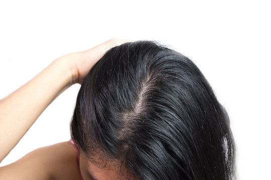 women head with dandruff Caused by the problem of dirty. Or caused by skin disease or Seborrheic Dermatitis. It has white scaly and it will cause itch.