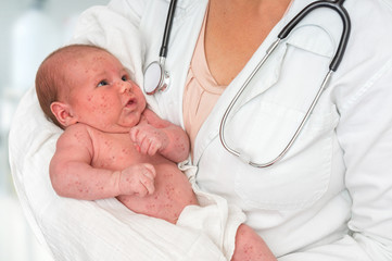 Doctor holding a newborn baby which is sick rubella or measles