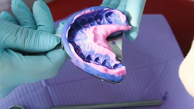 The dentist makes a cast of teeth for prosthetics from a special plastic mass of white and blue. orthopedic dentistry