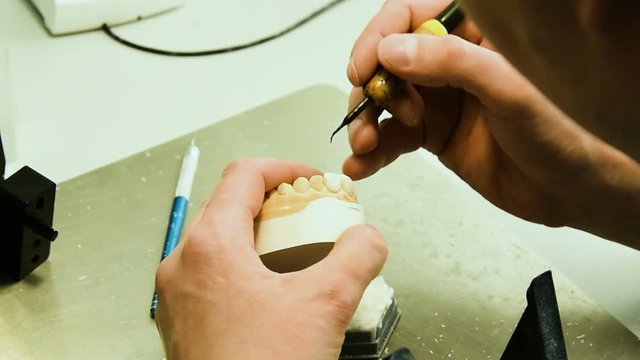 Dentist makes a dental implant prosthesis made of plaster cast. Orthopedic dentistry, prosthetics.