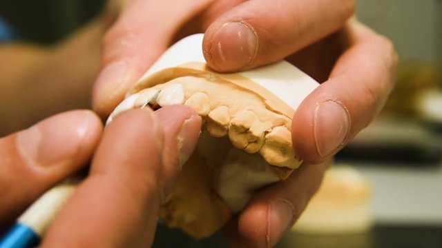 Dentist makes a dental implant prosthesis made of plaster cast. Orthopedic dentistry, prosthetics.