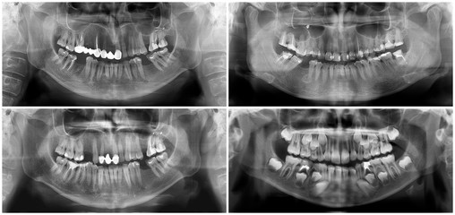 Panoramic dental x-ray digital image of upper and lower jaw. Radiograph scanning of maxilla and mandible. Focal plane tomography to thirty-year-old woman, forty-year-old man, child aged seven years