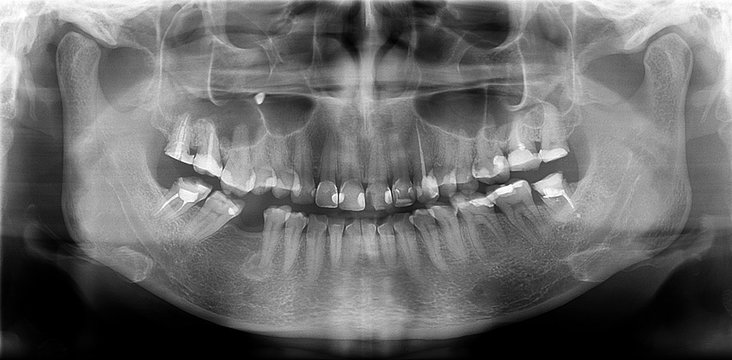 Panoramic radiograph is a panoramic scanning dental X-ray of the upper and lower jaw. This is a focal plane tomography depicting the maxilla and mandible of a thirty-year-old woman.