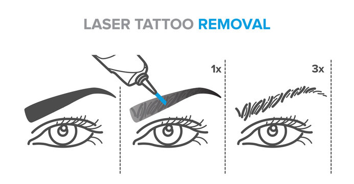 laser permanent makeup removal stages, eyebrow tattoo removal procedure