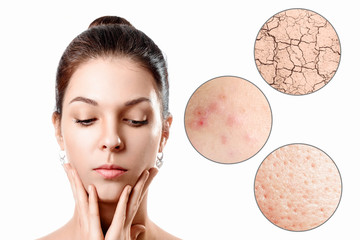 Young woman with acne, dry skin, black dots skin in zoom circle . Skin care concept. Young girl,...