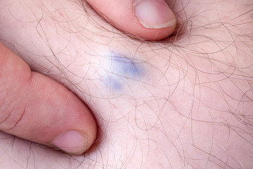varicose vein disease in a man, closeup image