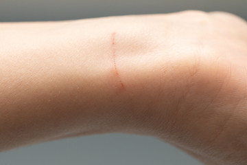 Healing cut on wrist