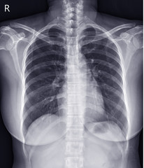 Chest x-ray normal.
