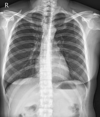 Chest x-ray normal.