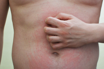 A man scratching an irritated stomach. Urticaria on his stomach.Allergic reaction.