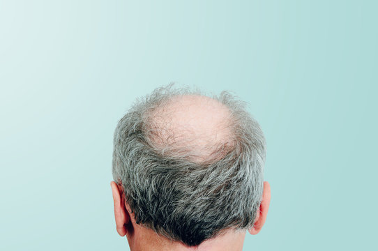 รูปภาพHairloss – เลือกดูภาพถ่ายสต็อก เวกเตอร์ และวิดีโอ99,263 | Adobe Stock