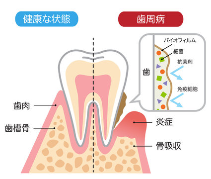 健康な歯と歯周病　バイオフィルム　断面図