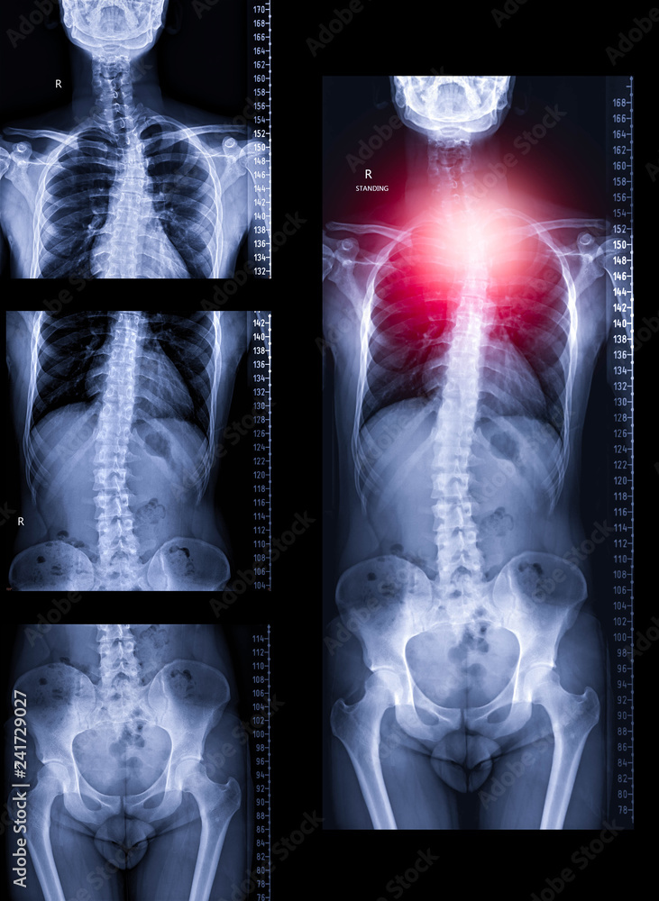 Poster x-ray image of whole human spine before and after image processing .