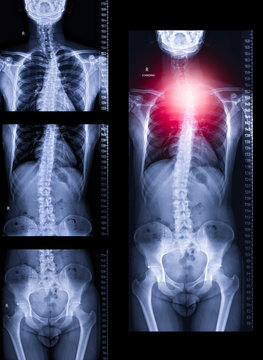 X-ray image of Whole human Spine before and after image processing .
