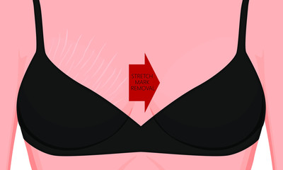 Vector illustration of a human body problem. Stretch marks removal on European, Asian female or woman breast. For advertising, medical publications, use on package of medicinal products, creams